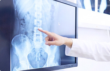 骨粗しょう症の治療